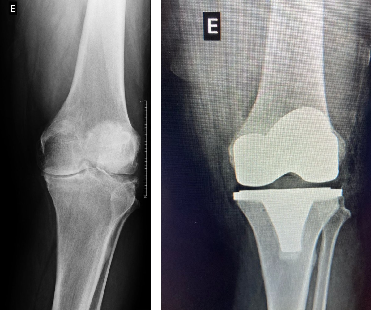 Radiografia comparativa do mesmo joelho antes e depois da artroplastia total - caso clínico
